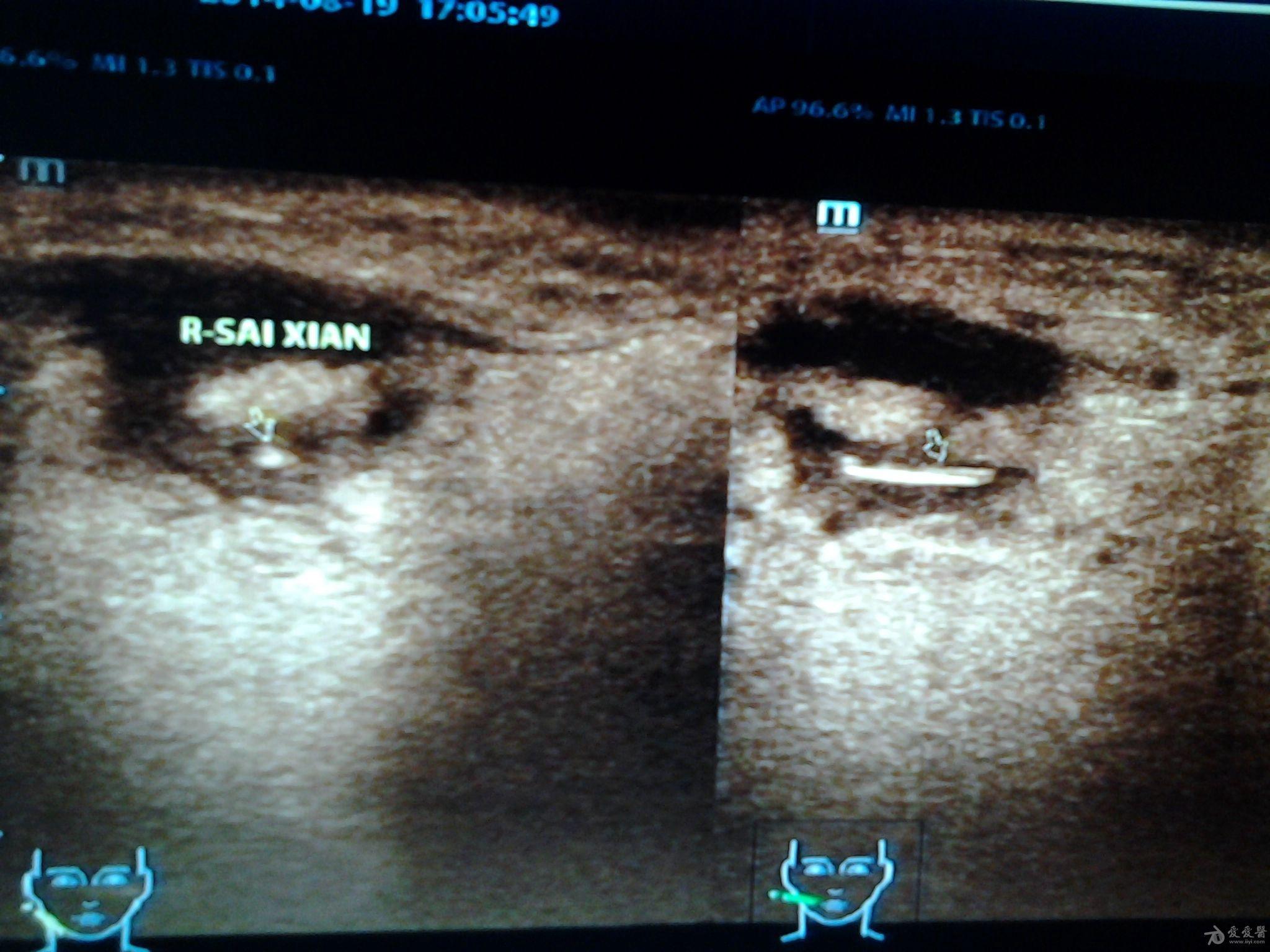 右侧腮腺包块 超声医学讨论版 爱爱医医学论坛