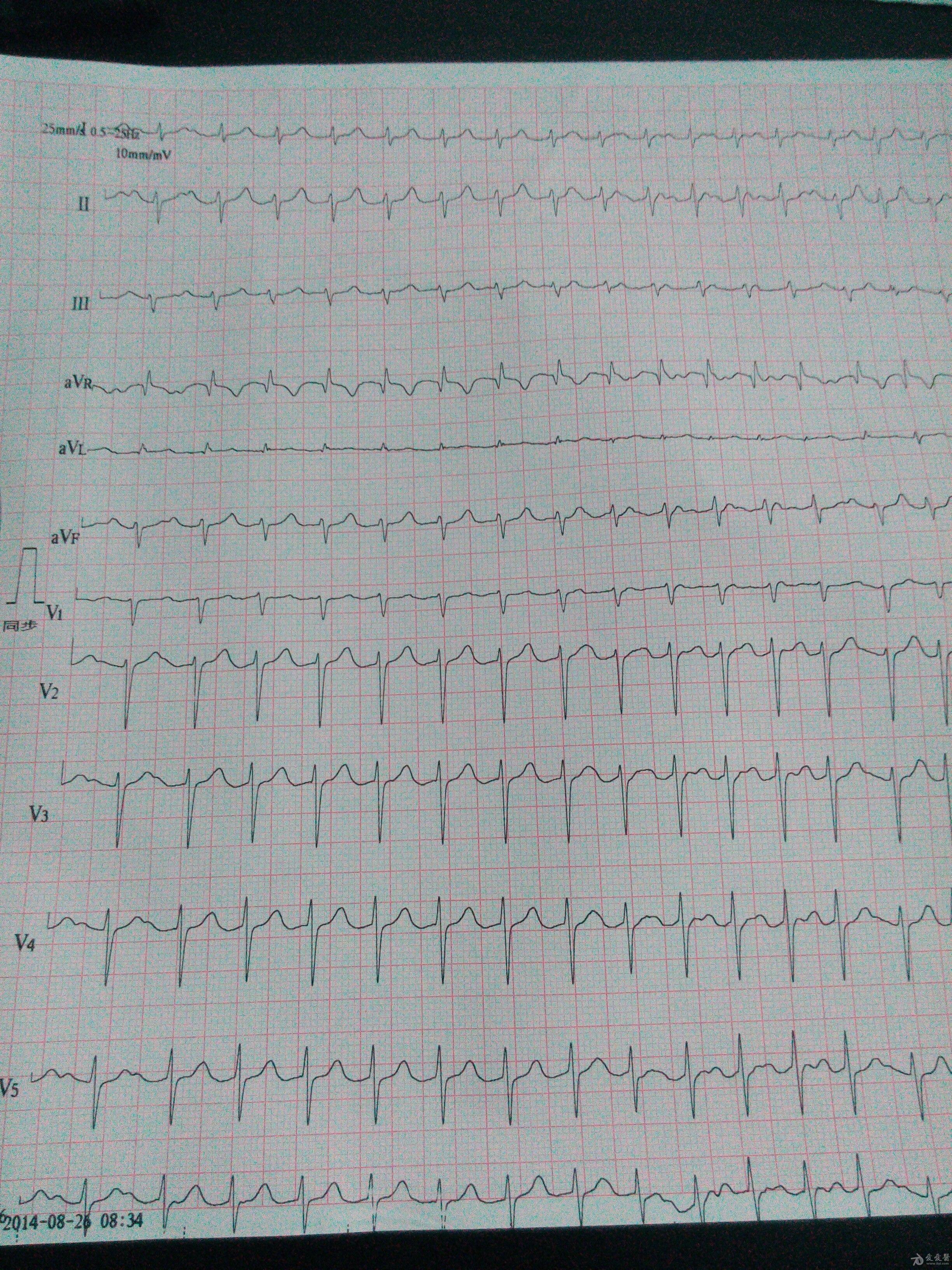 什么类型的室上速? - 心电图脑电图专业讨论版 - 爱爱