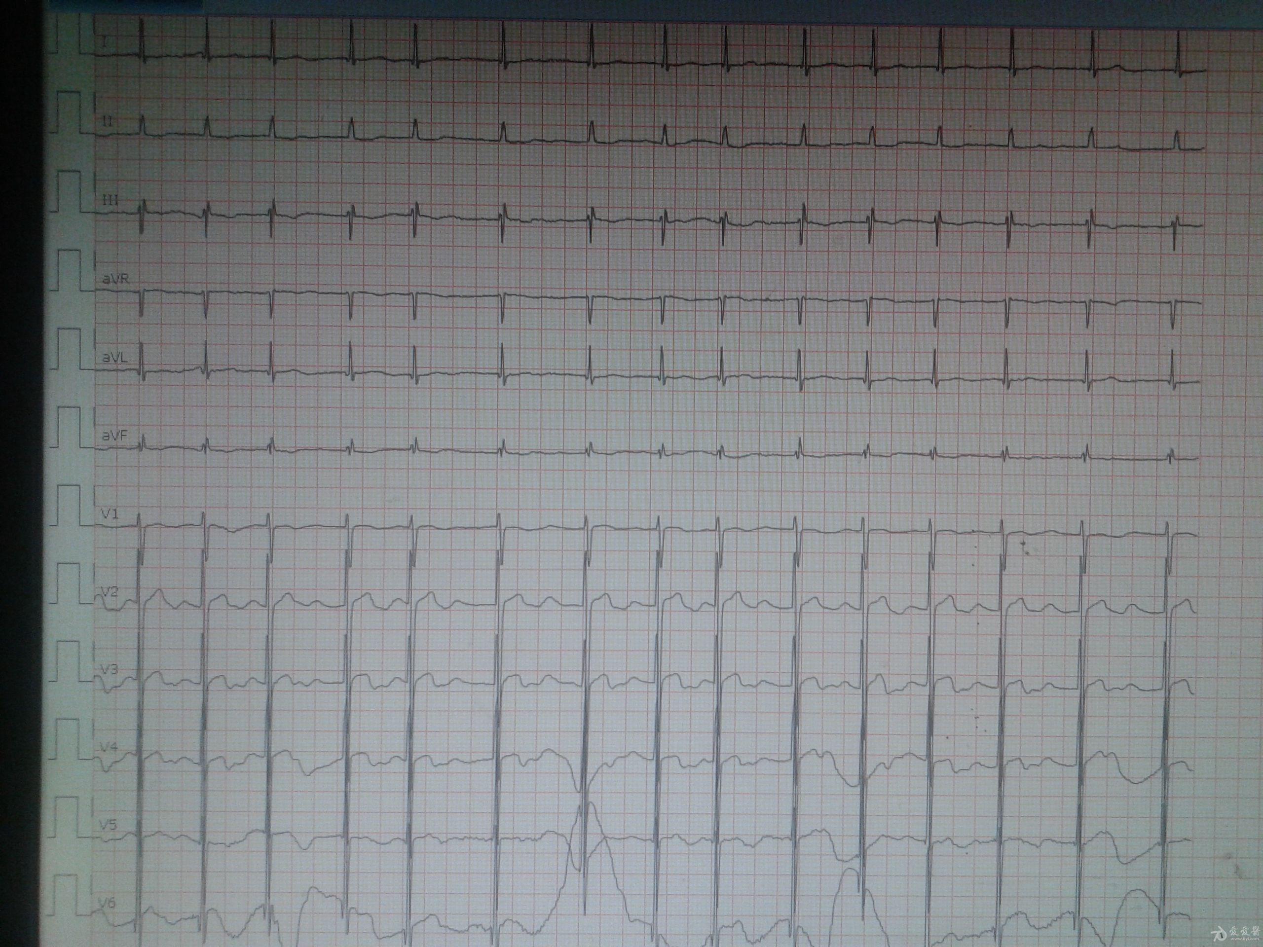 电交替室上速? - 心电图脑电图专业讨论版 - 爱爱医医学论坛