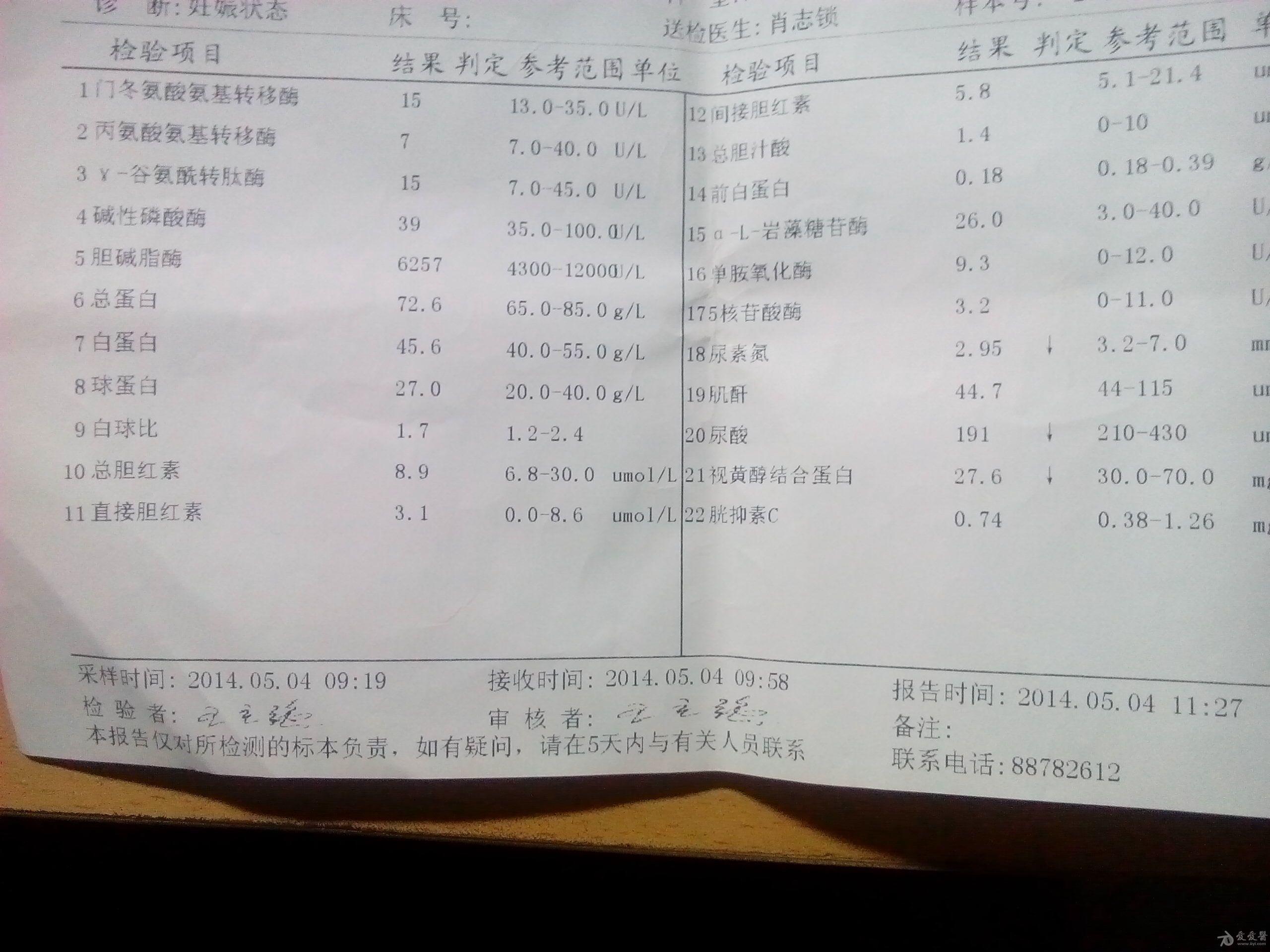 双肾窦结石