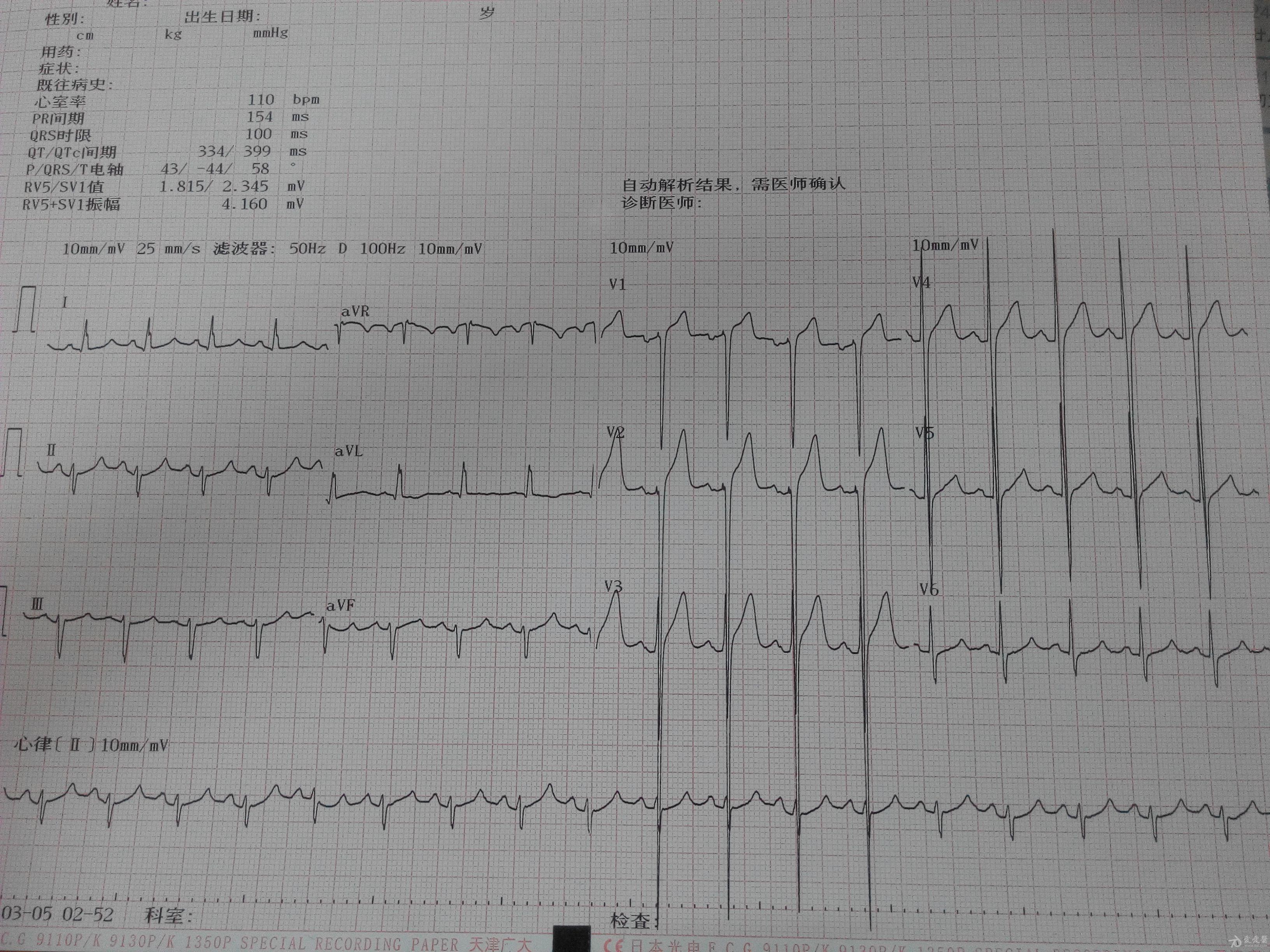 心电图分析心室高电压