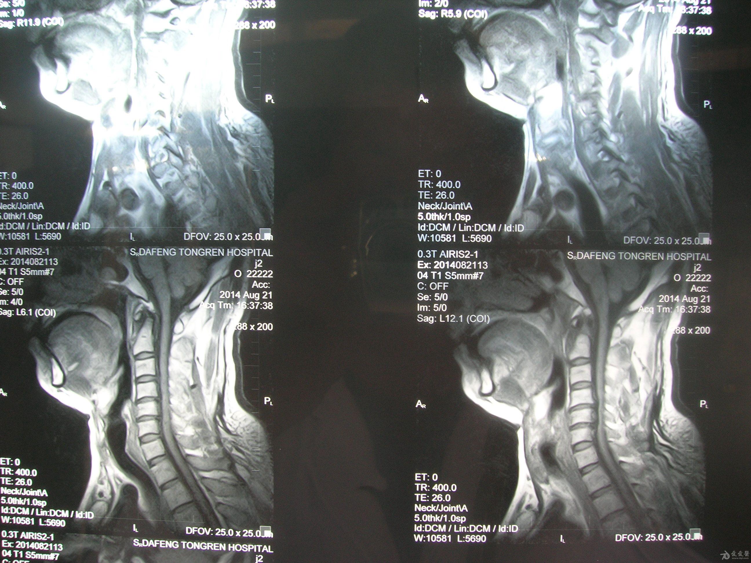 帮我看看脊髓型颈椎病的片子