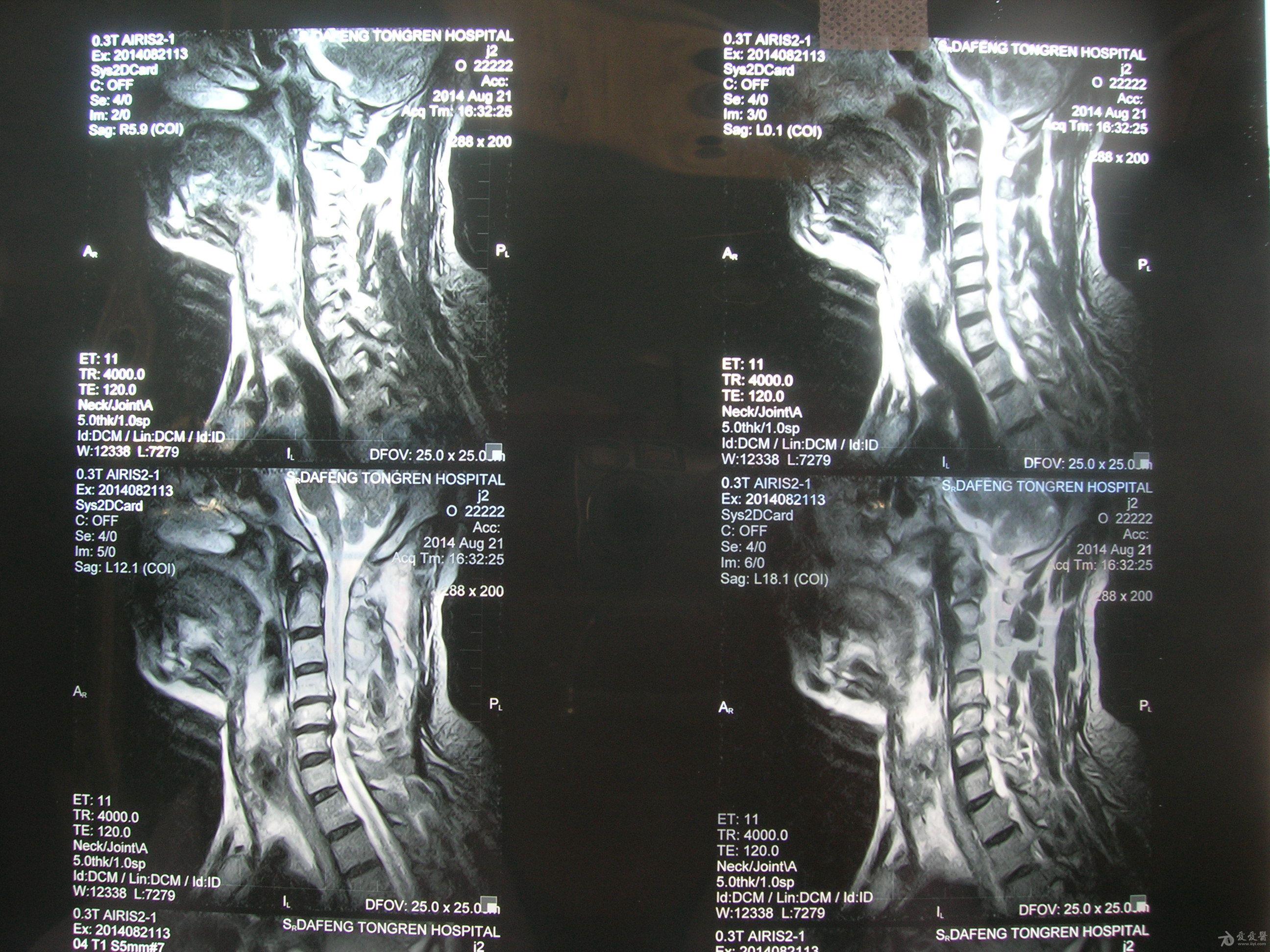 帮我看看脊髓型颈椎病的片子