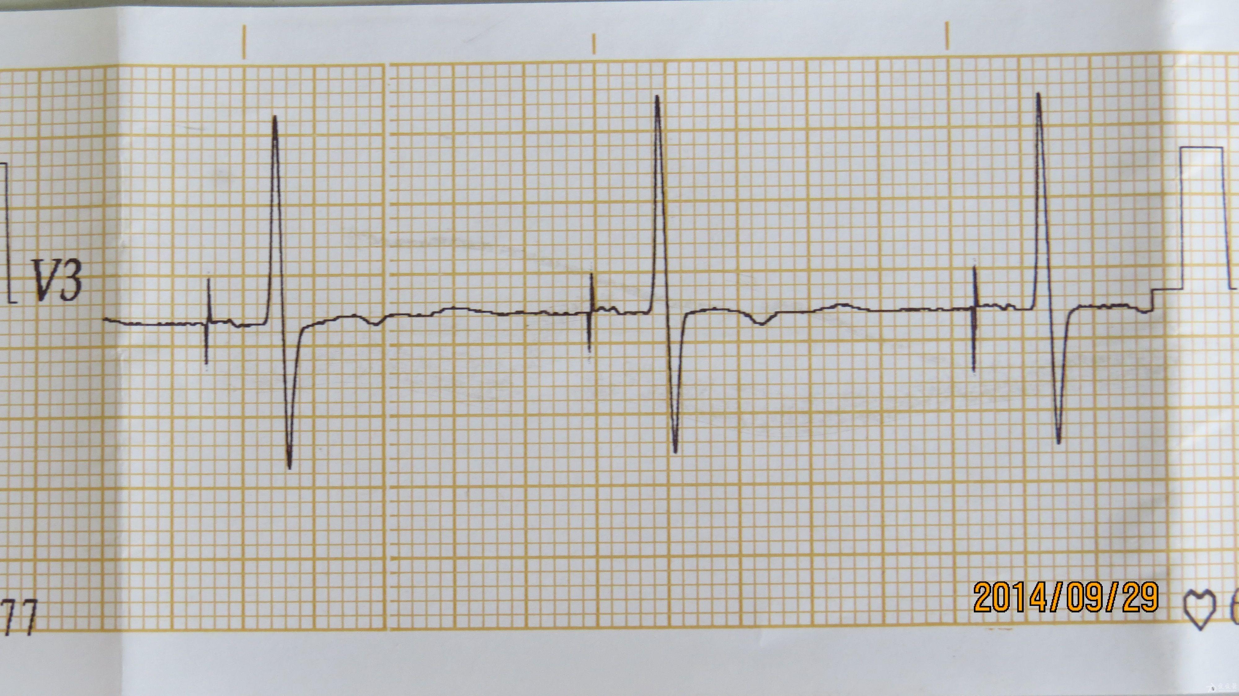 安装起搏器三年后的心电图
