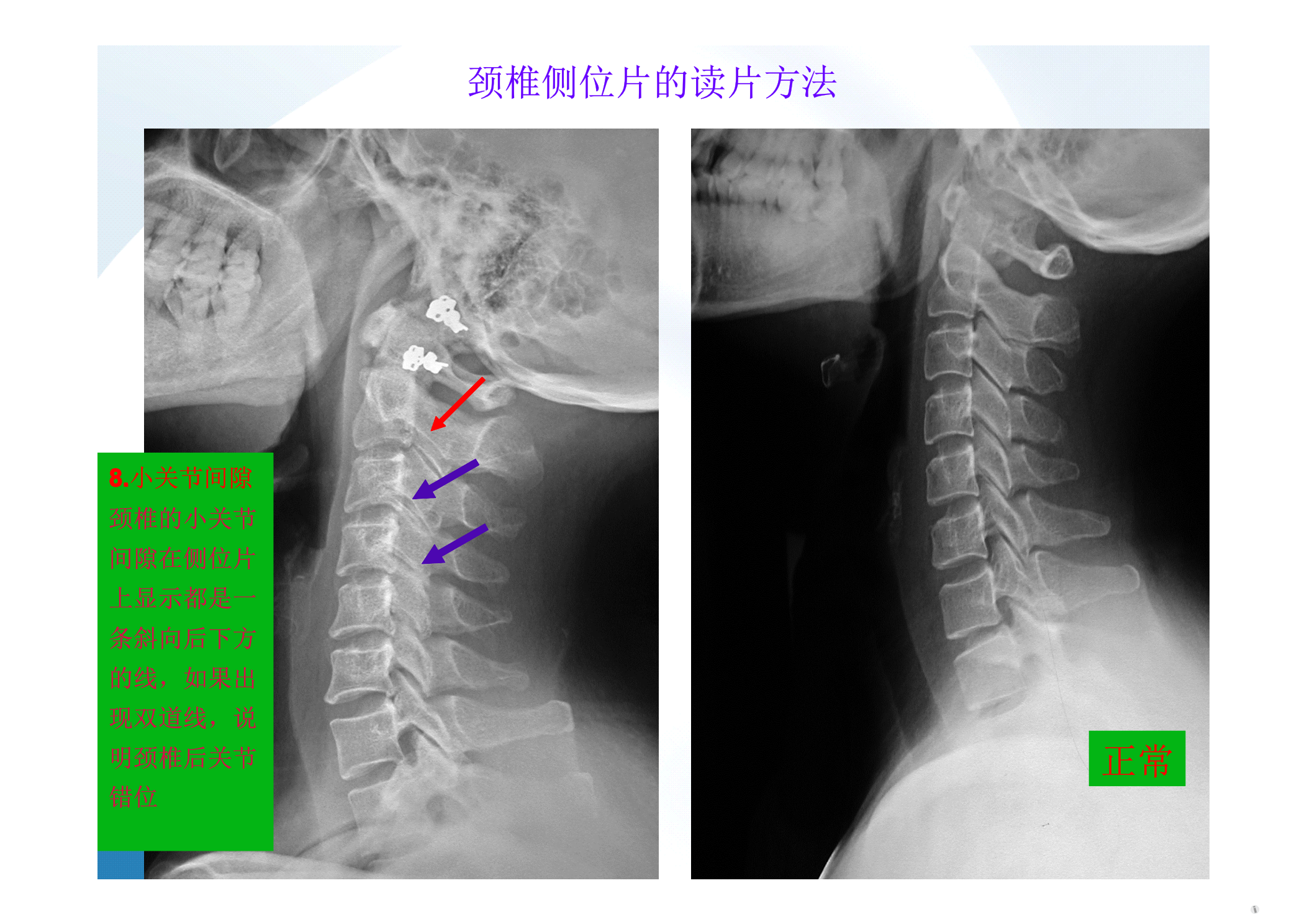 颈椎读片方法与颈椎病影像表现,灰狼吐血原创,转载请注明出处!