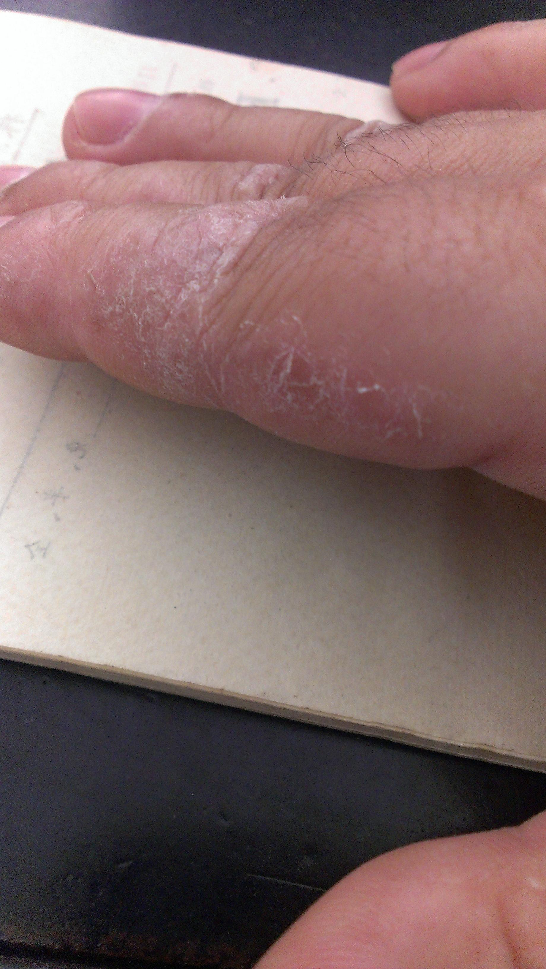 请大家看下这到到底是分别是湿疹还是真菌感染手癣足癣