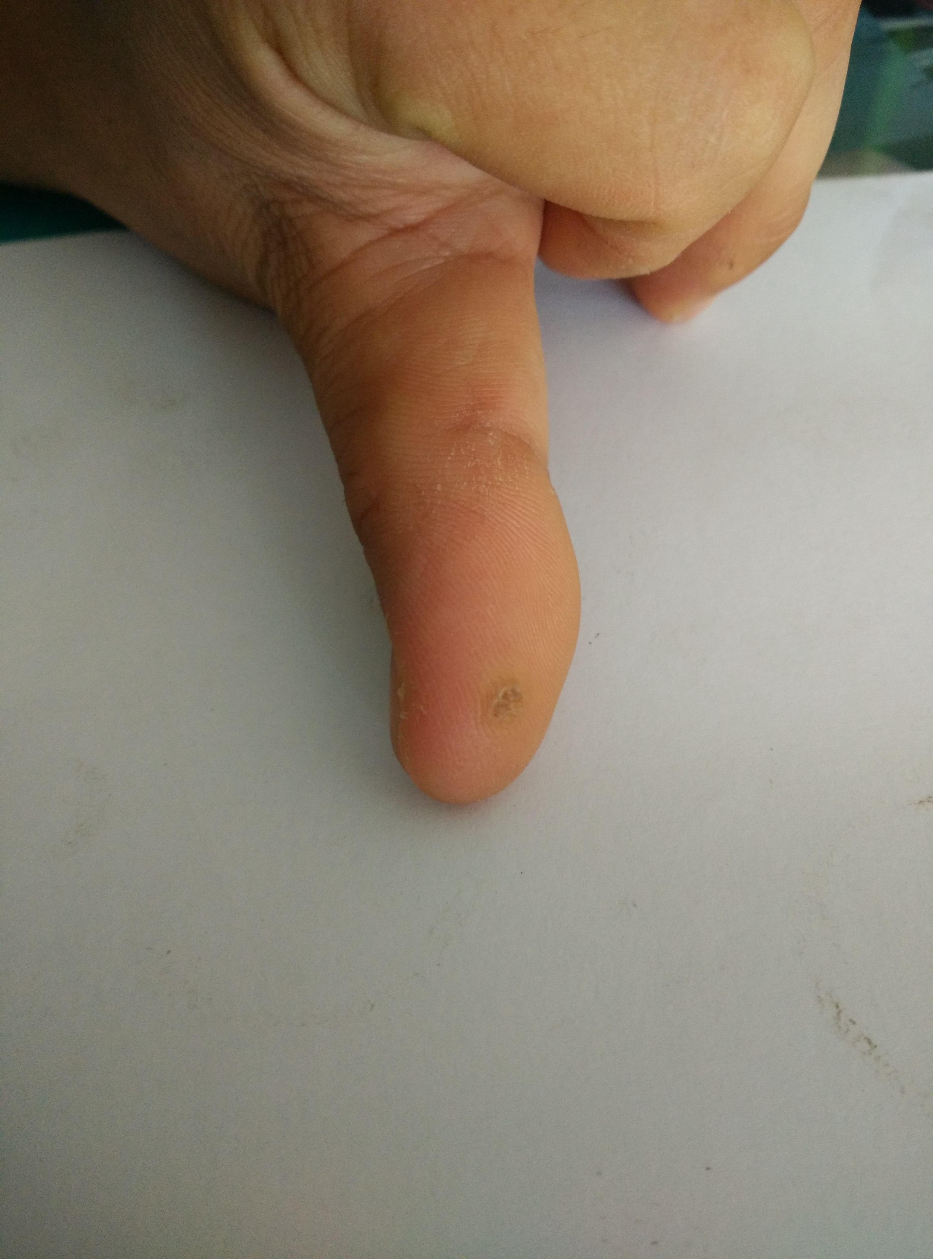 手上长的这个是不是病毒疣