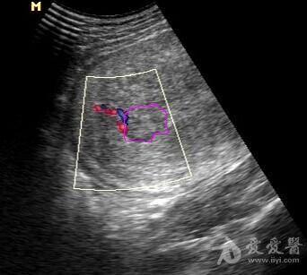 产后子宫宫腔内有问题么? - 超声医学讨论版 - 爱爱