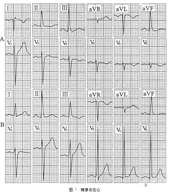 [心电图分析] 大家请看,一例与众不同的右位心心电图!
