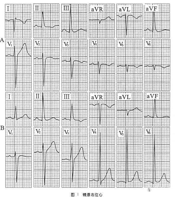 大家请看一例与众不同的右位心心电图