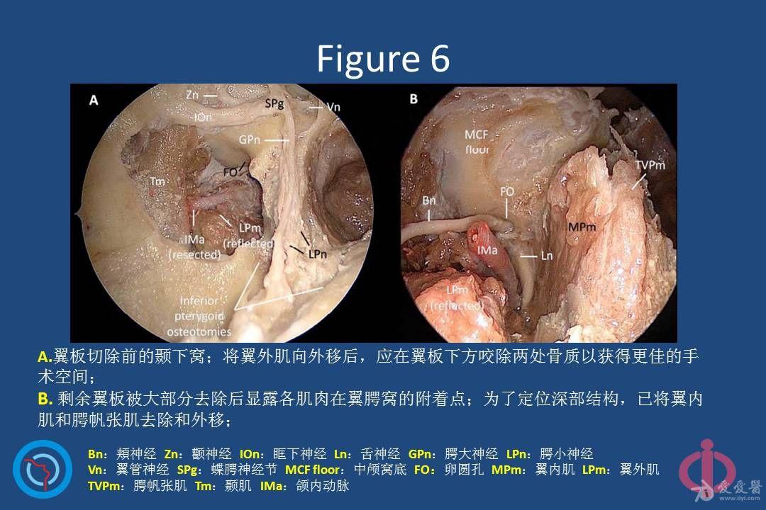 内镜下经鼻腔切除翼腭窝,颞下窝和茎突后结构