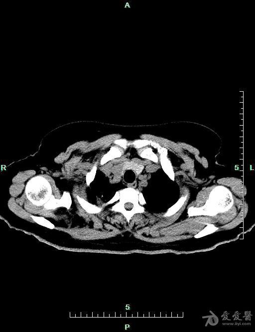 胸腺ct