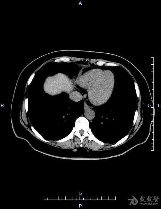 胸腺ct