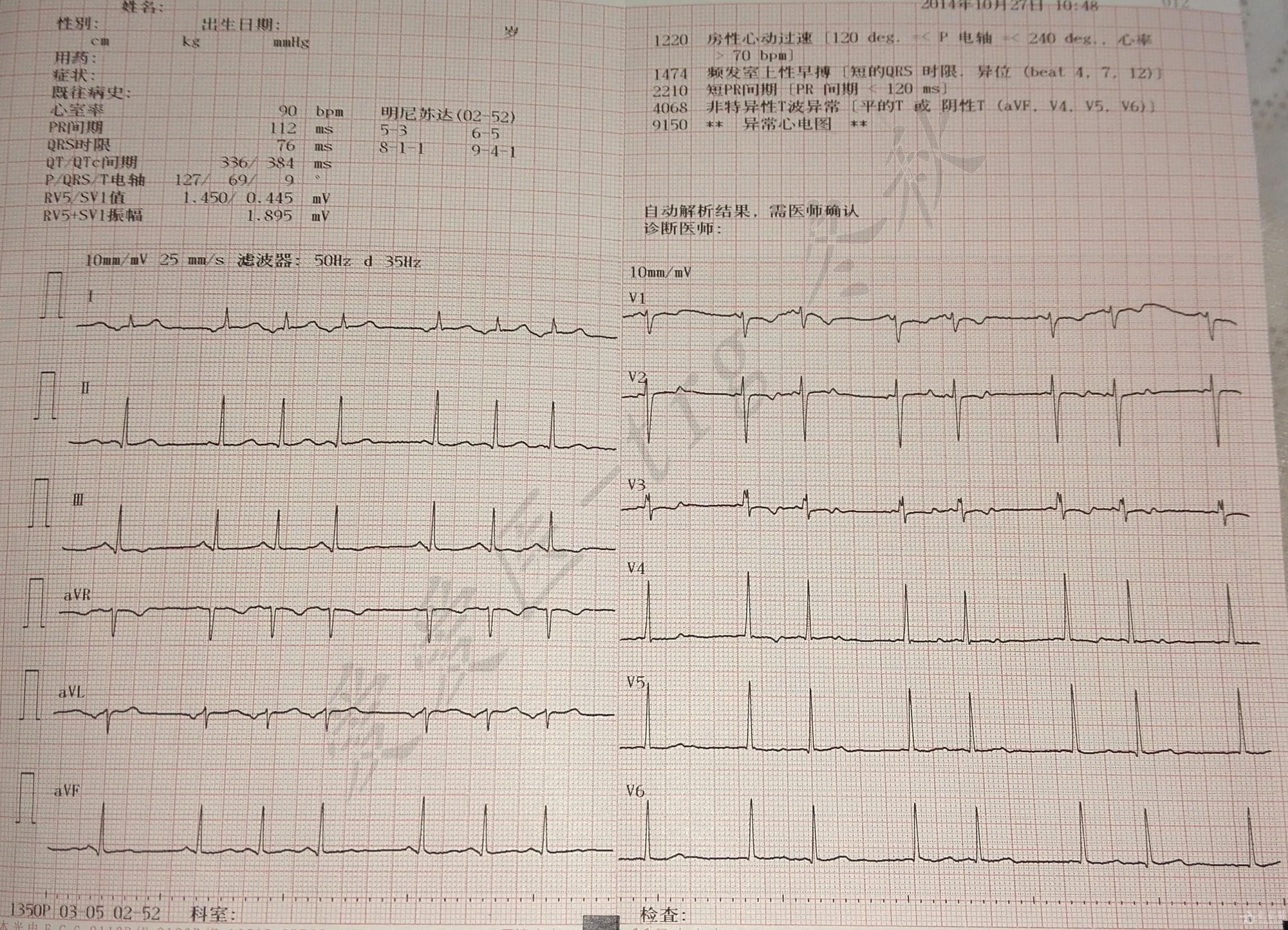 冬秋心电图讨论20141120导联pi倒置