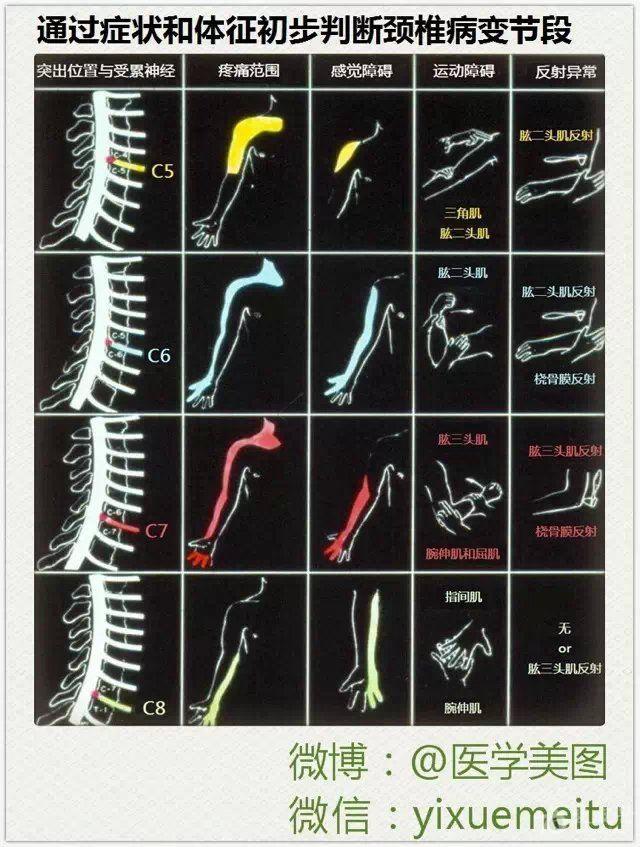 通过症状和体征初步判断颈椎病变阶段 - 神经内科讨论版 - 爱爱医医学