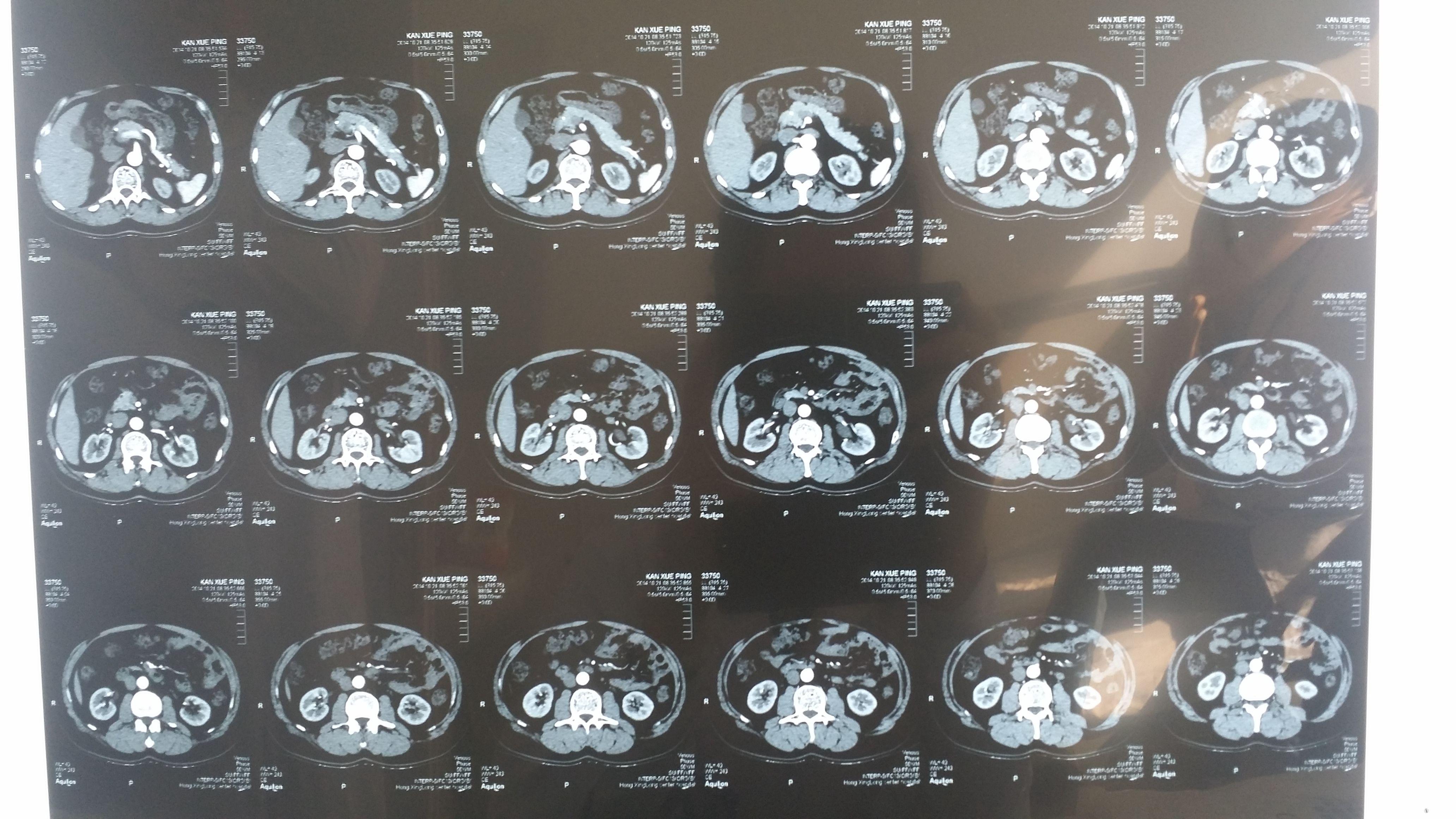 请前辈老师阅一下加强肾ct片诊断什么病