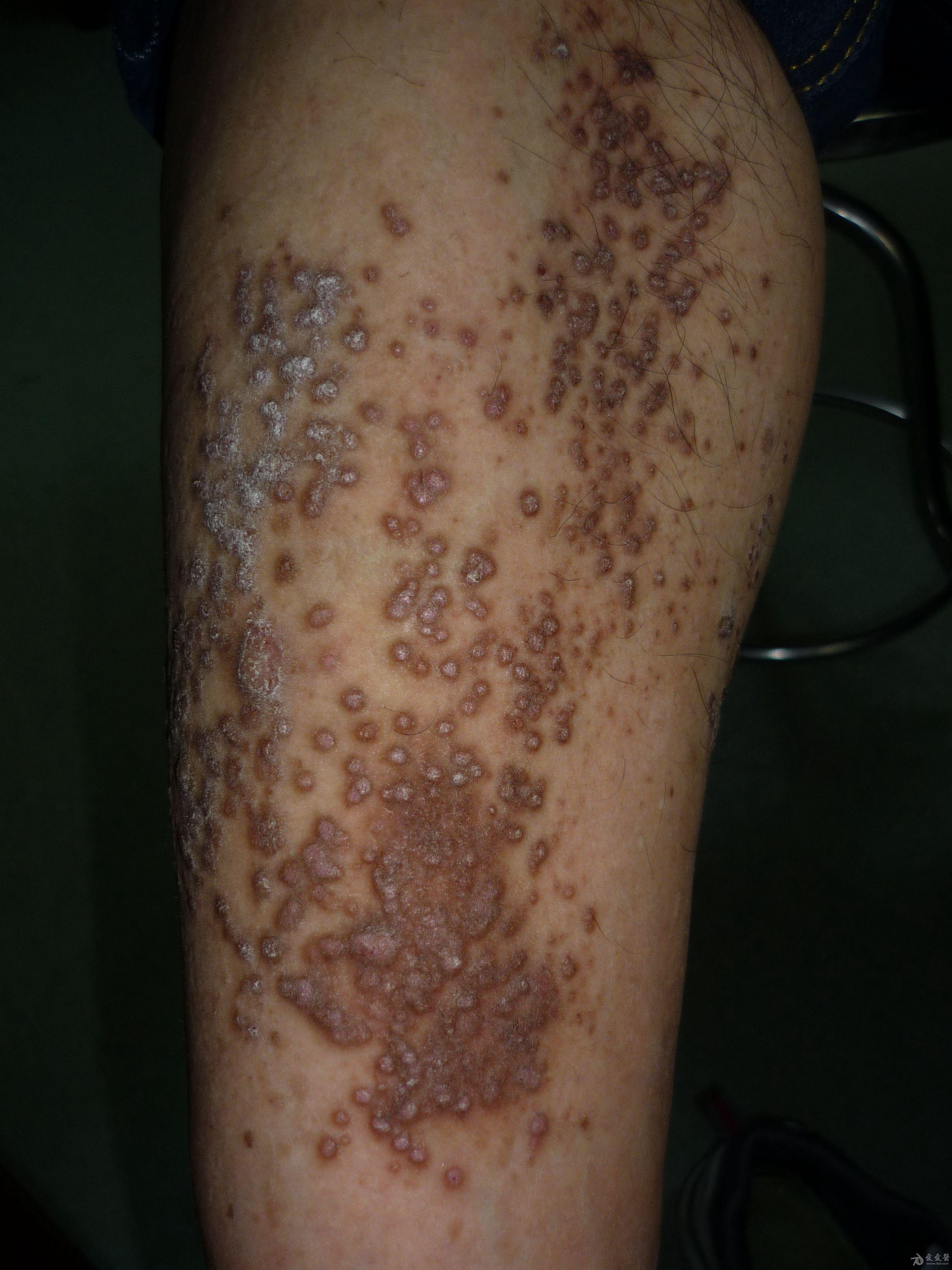 典型病例——苔藓样淀粉样变 - 皮肤及性传播疾病讨论