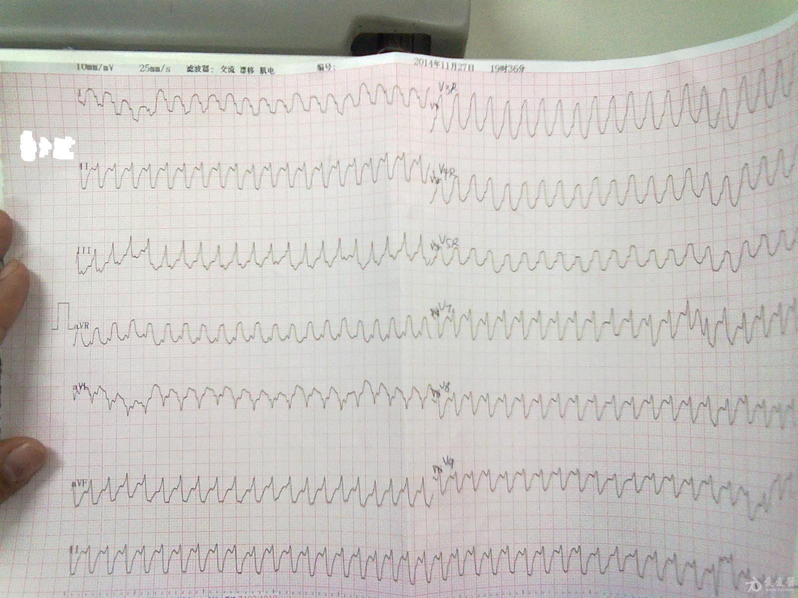 请教各位老师这个心电图是室性心动过速吗
