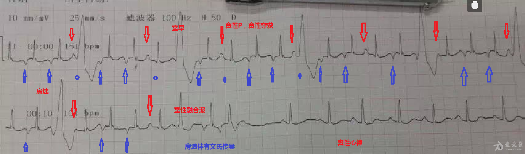 然后恢复窦性心律,是否可以考虑房速的基础上,偶有窦性激动夺获心室