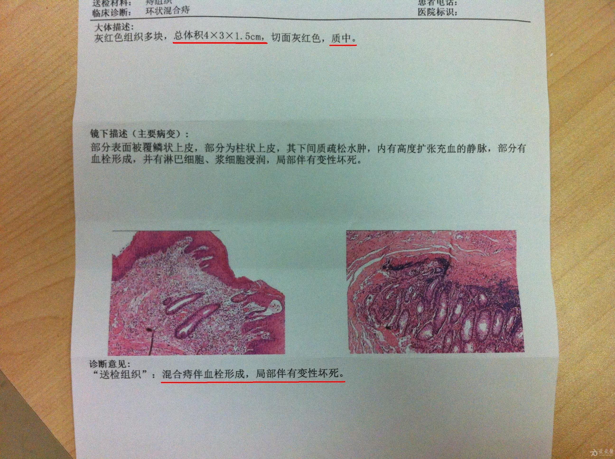 今天收的环状混合痔病人