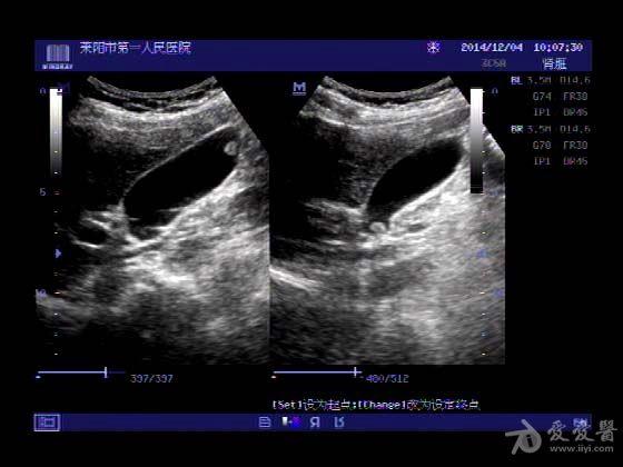 超声入门贴382--------容易误诊为胆囊息肉的病例