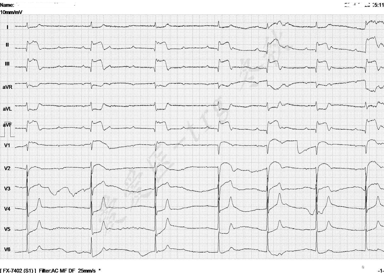 冬秋心电图讨论20141218急性心梗