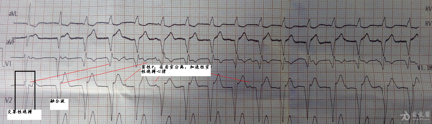 电图分析 发表于 2014-12-23 16:03|显示全部楼层   窦性p,有房室分离