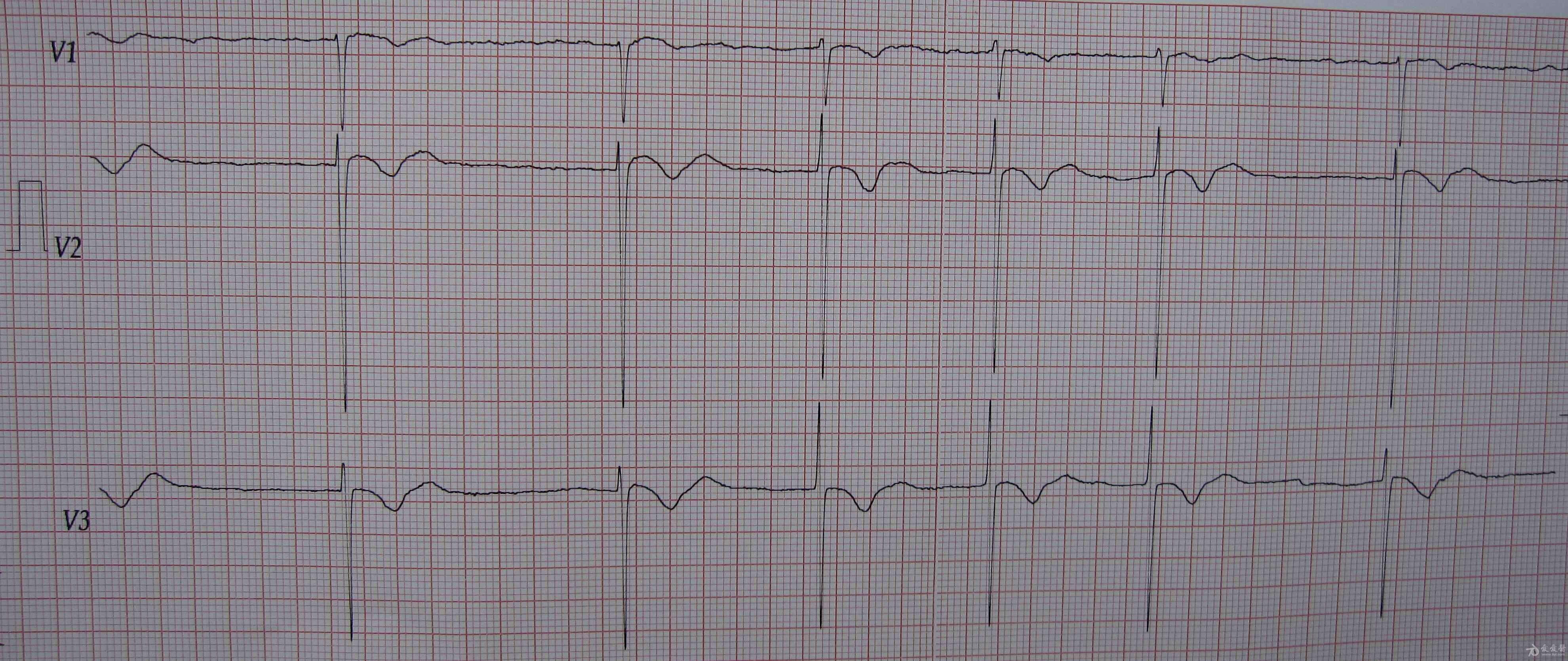 一例服地高辛1天1片(约4周)的病人心电图
