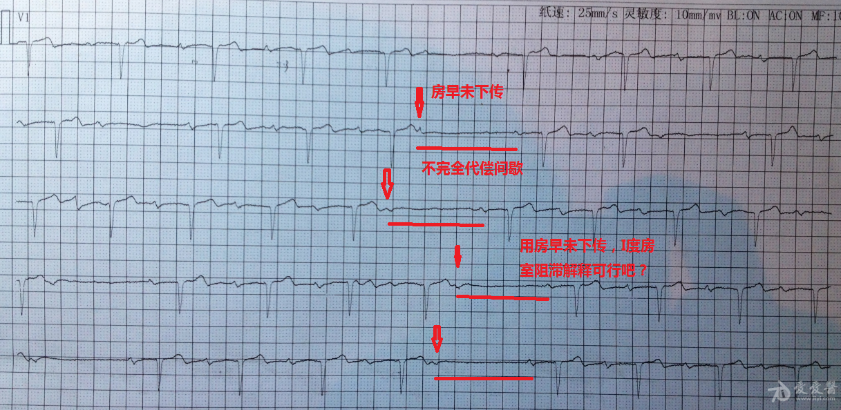 请老师帮忙分析 心电图脑电图专业讨论版 爱爱医医学论坛