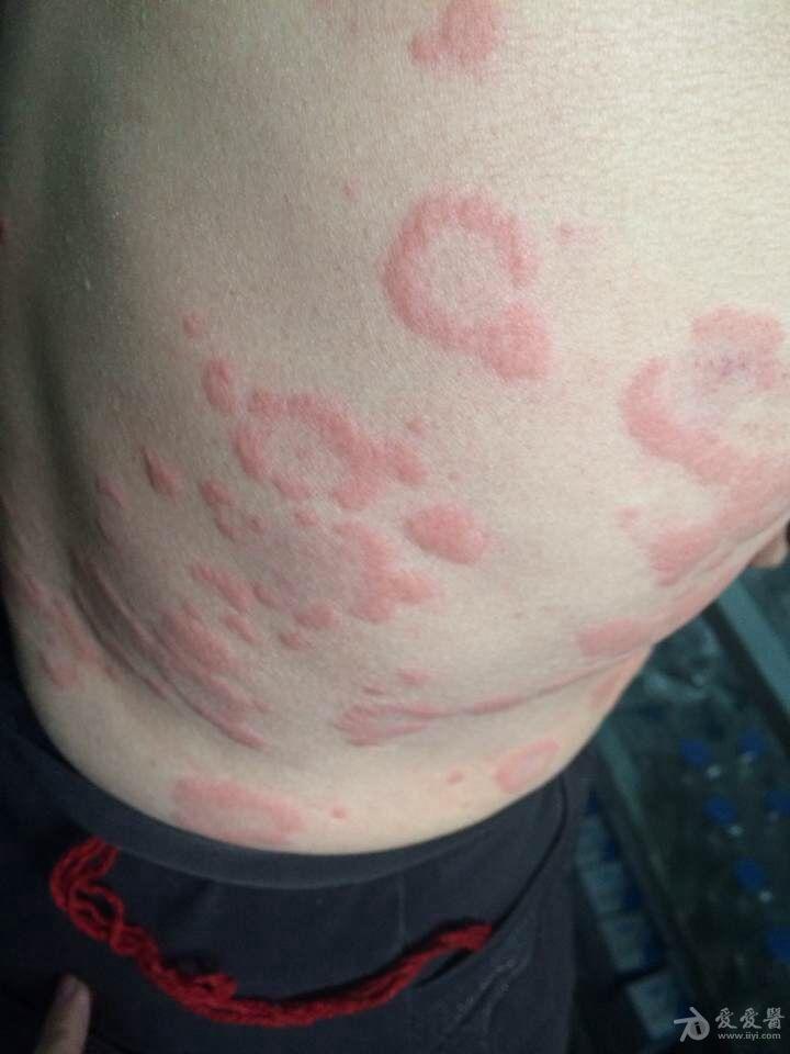 这是荨麻疹吗?