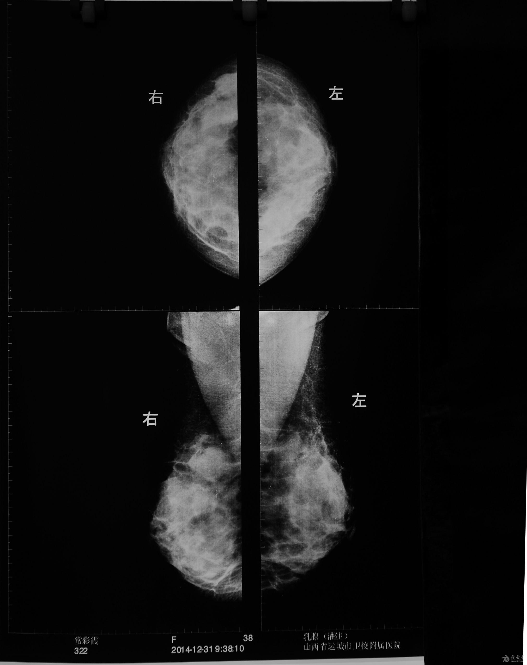 这张乳腺钼靶片有什么异常