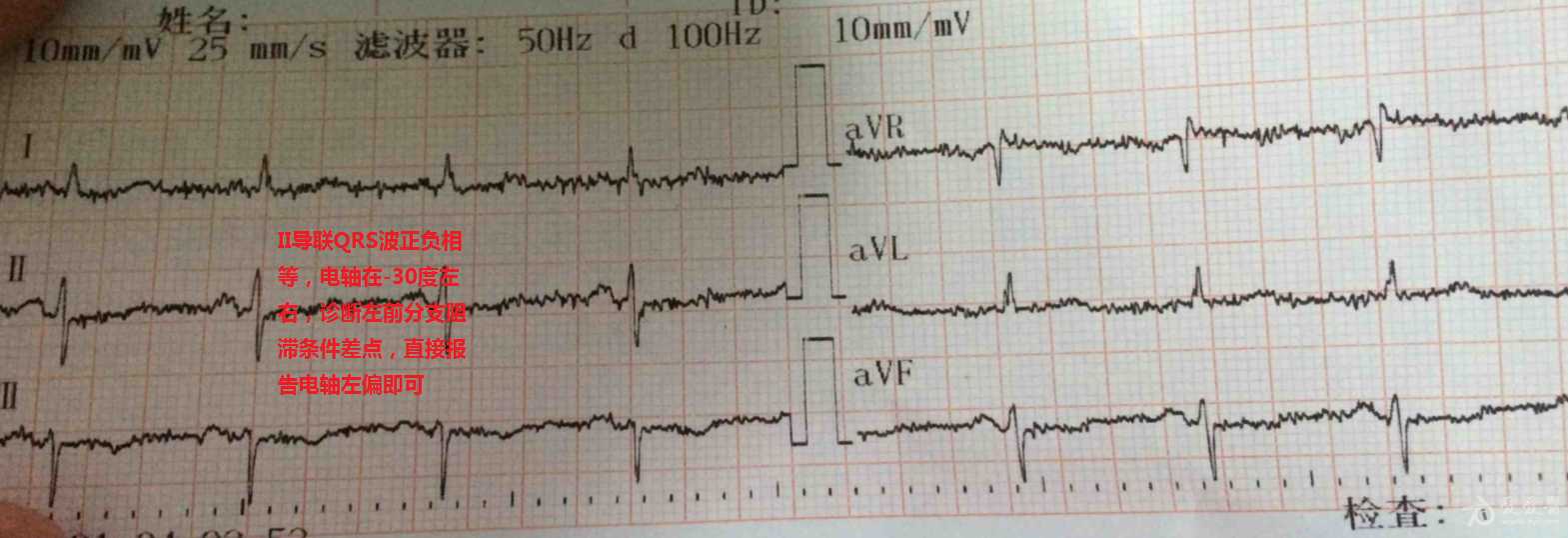 ii导联qrs波正负相等,电轴在-30度左右,诊断左前分支阻滞条件差点
