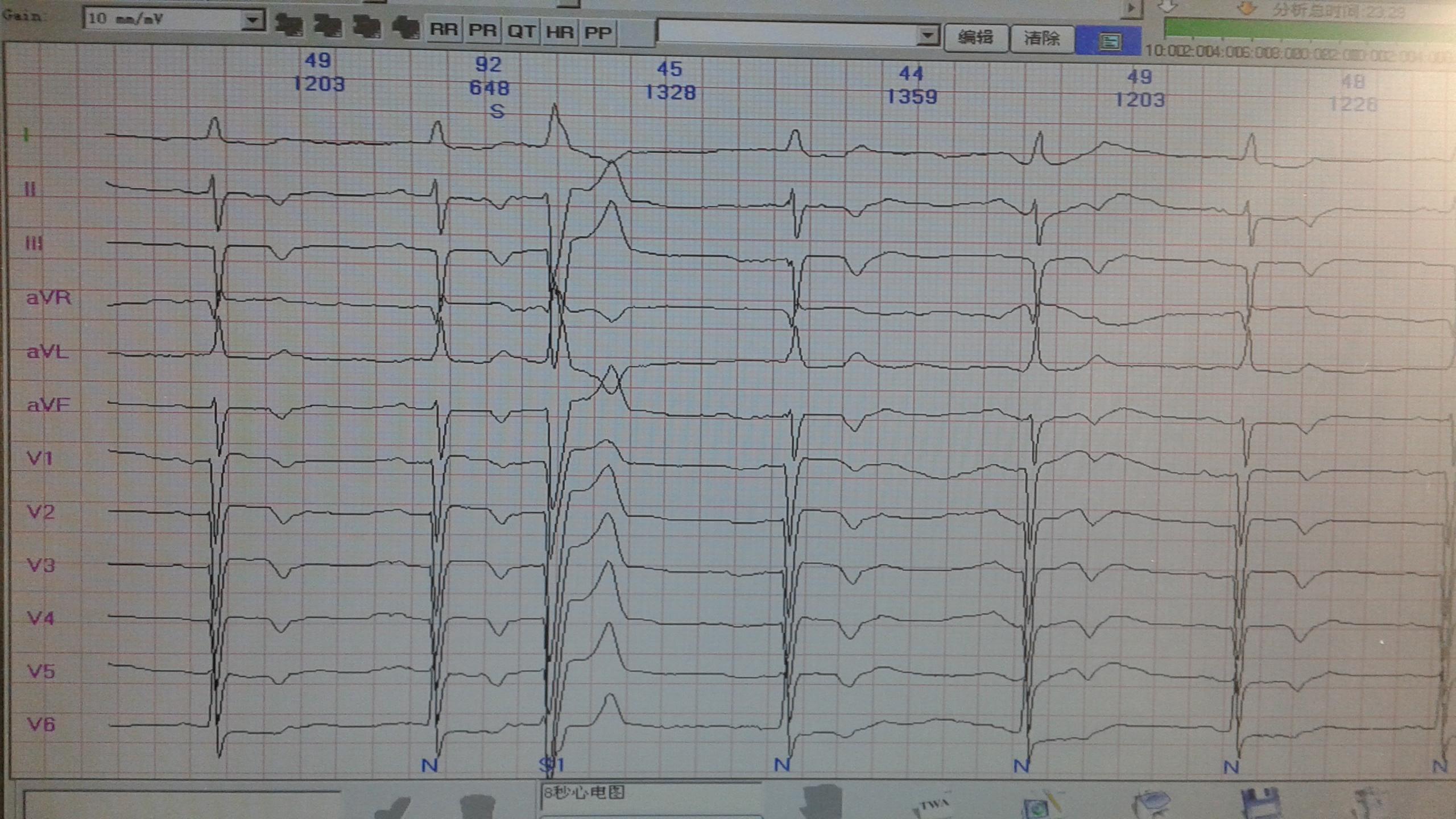 是间隙性完左,房早伴差传,室早? - 心电图脑电图专业