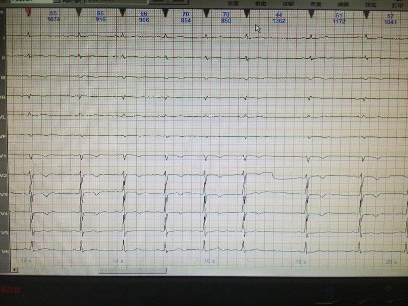 求诊断二度一窦房阻滞 ?窦性不齐
