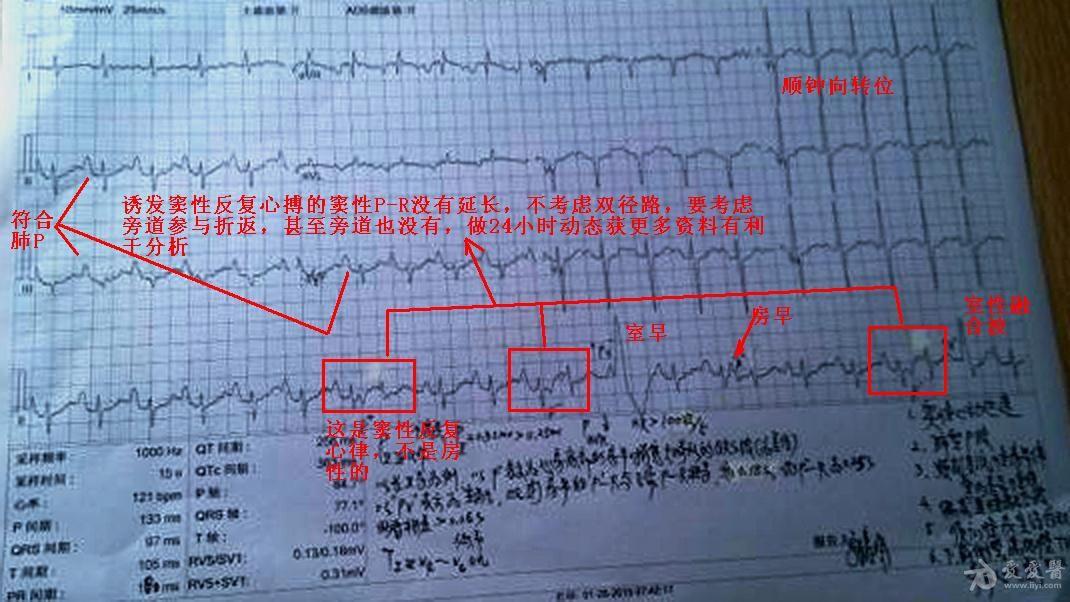 心电图分析一个慢阻肺病人的心电图请教老师