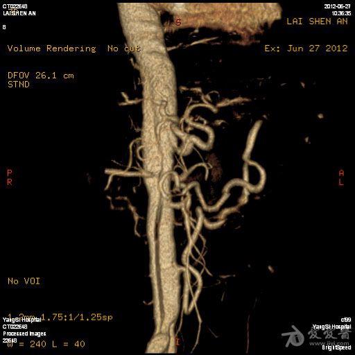 腹主动脉及双侧髂总动脉夹层主动脉弓部动脉瘤cta