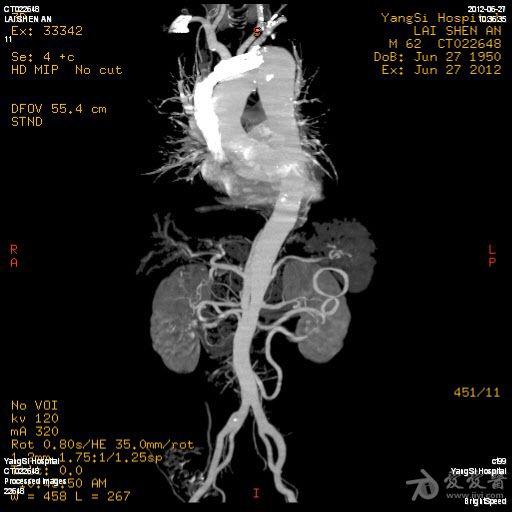 腹主动脉及双侧髂总动脉夹层主动脉弓部动脉瘤cta