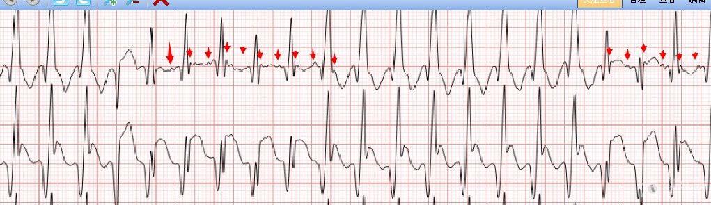 冬秋心电图讨论20150206宽qrs波心动过速
