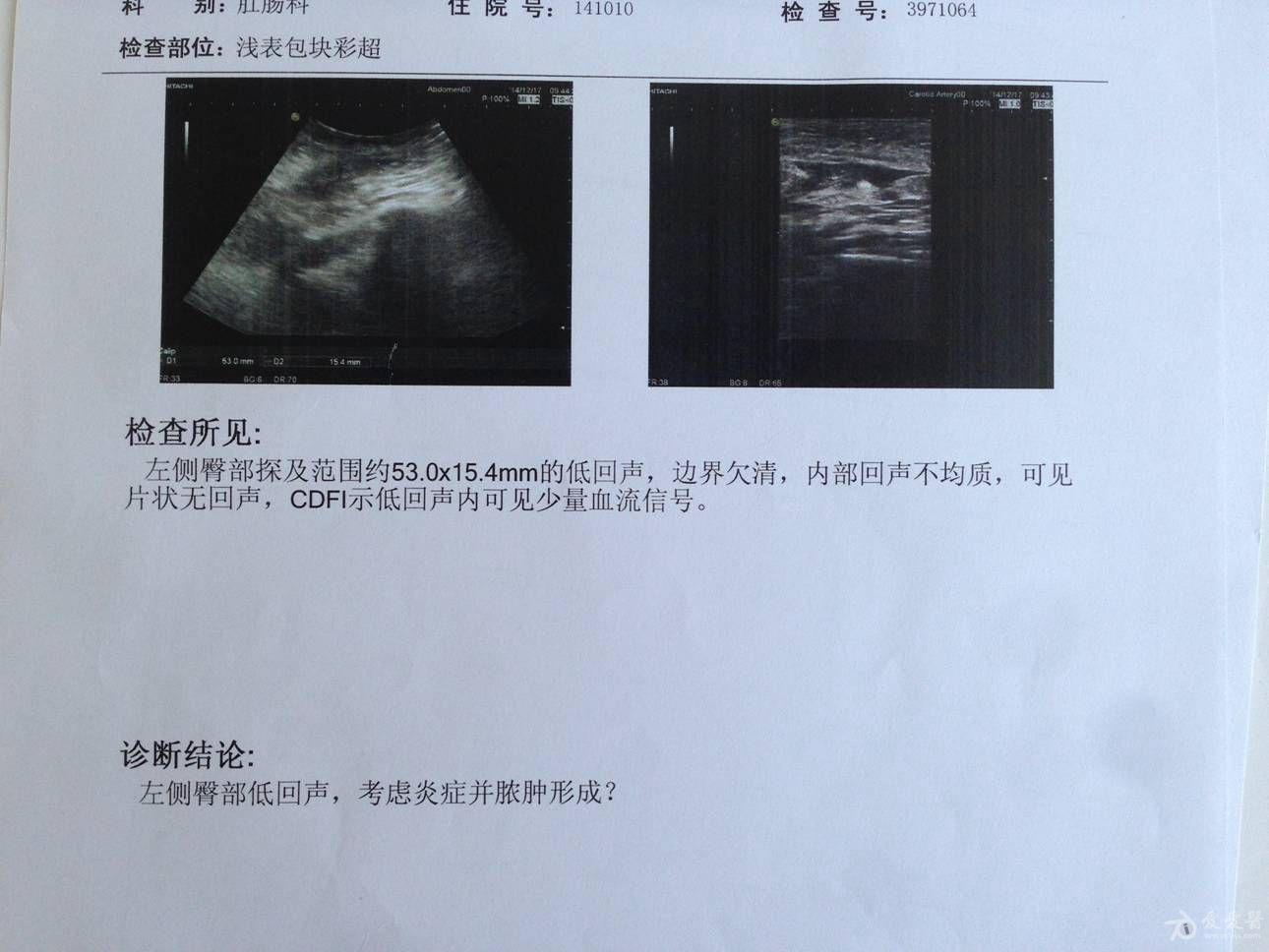 这个到底诊断是肛周脓肿还是肛瘘如何治疗才好求解