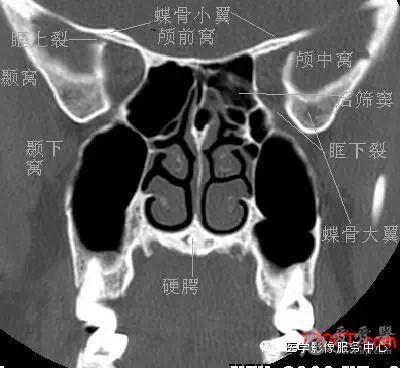 鼻窦眶下裂后部层面