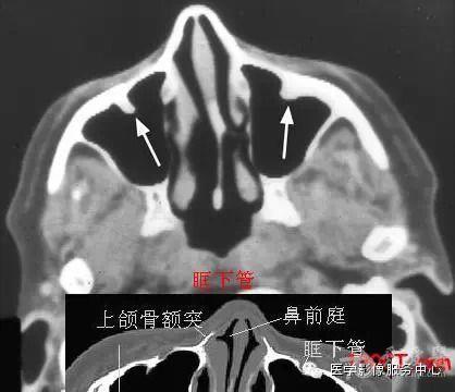 鼻窦断面解剖图片