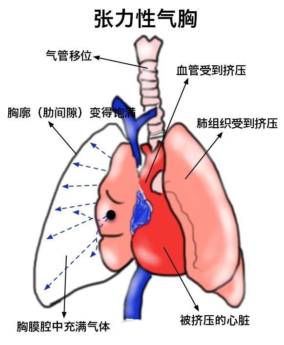 图解张力性气胸