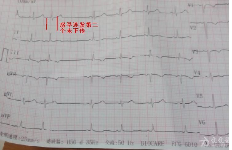 全图诊断房早连发,其中一个未下传.