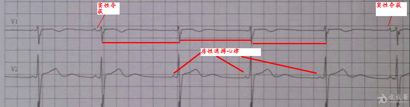 交界性逸搏或房性逸捕