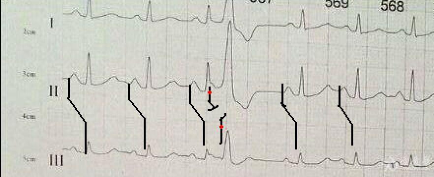 r on t 诊 断 - 心电图脑电图专业讨论版 - 爱爱医医学论坛