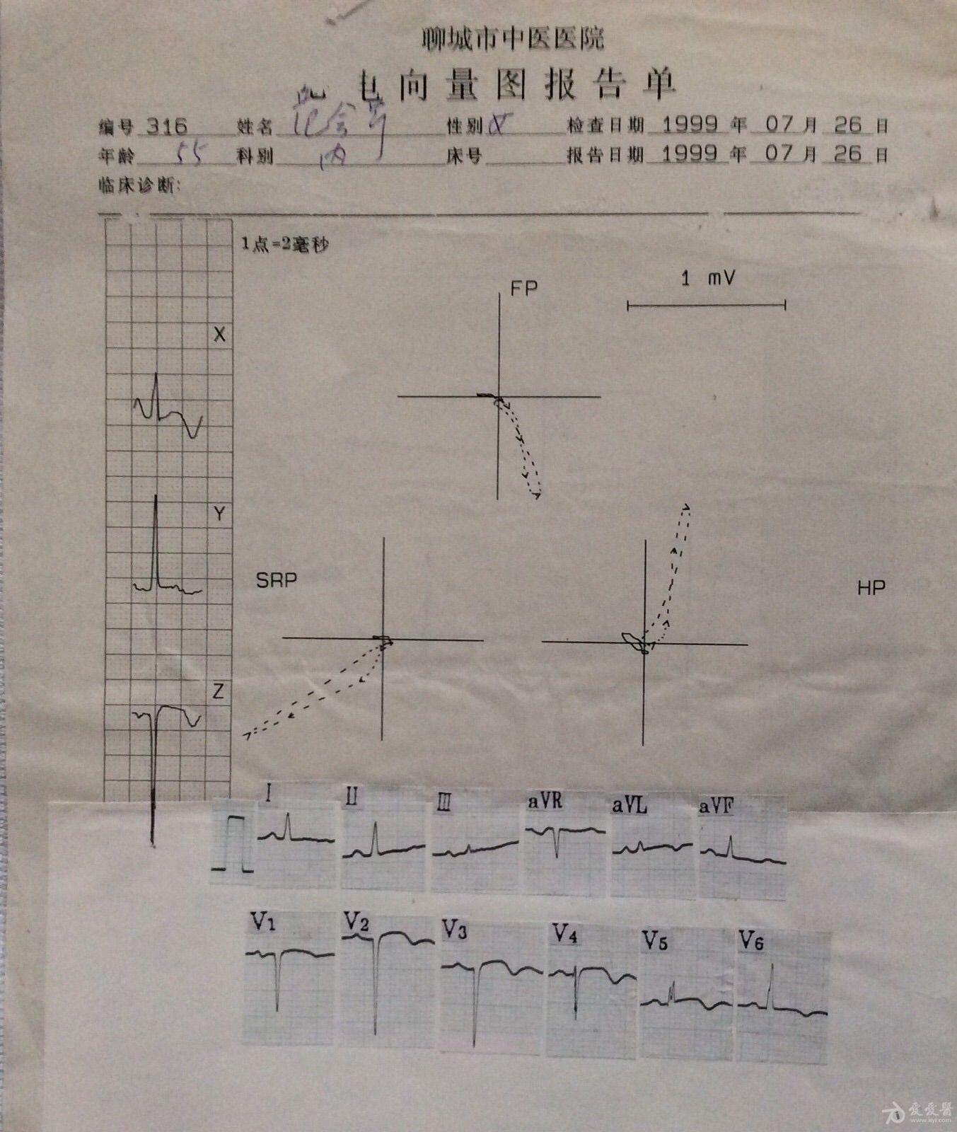 看心电图熟悉心向量图--图79--急性广泛前壁心肌梗死