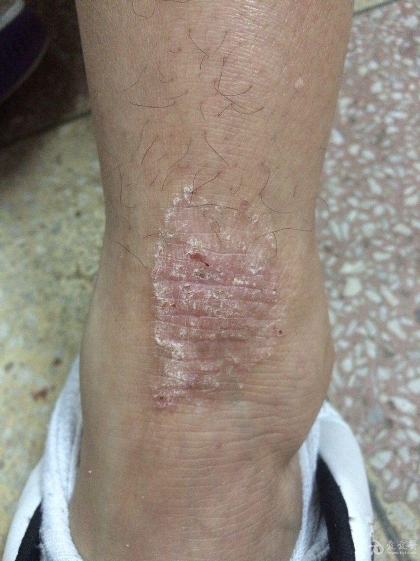 皮炎图片