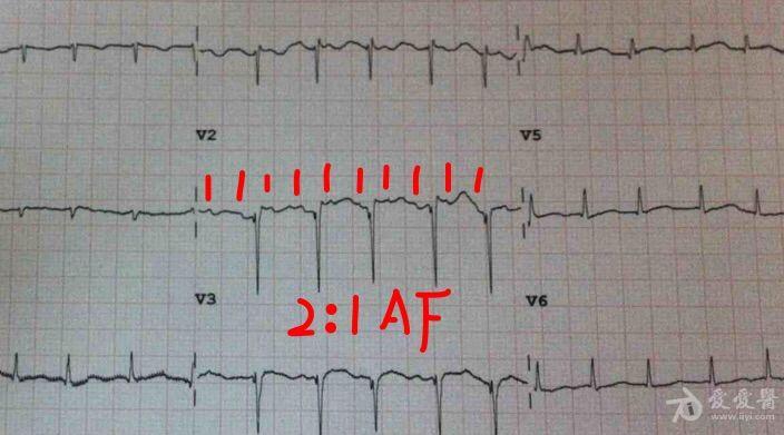 窦速,房颤? - 心电图脑电图专业讨论版 - 爱爱医医学