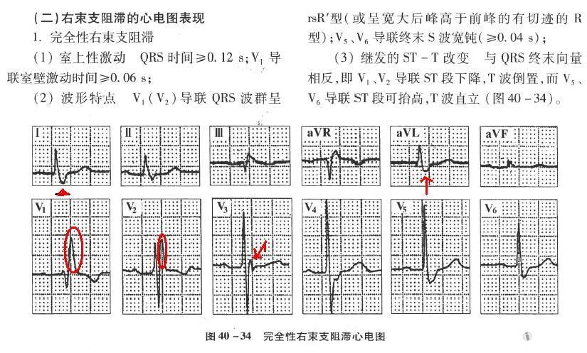 关于郭继鸿心电图学不完全性右束支阻滞图例的一点疑问