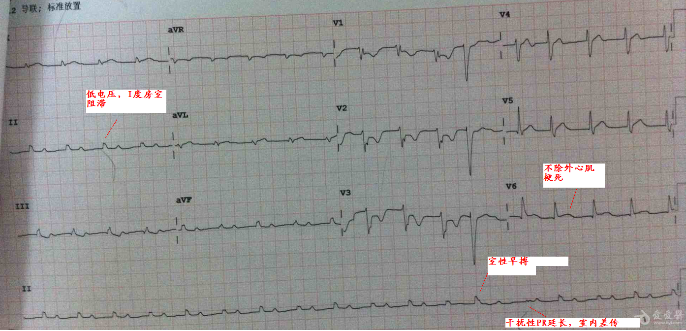 [心电图分析] 房室分离?